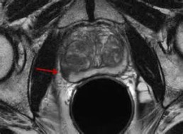 Prostate MRI